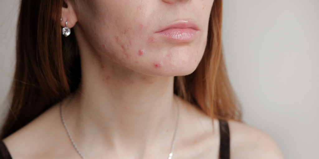 Which Type of Acne are You Fighting?